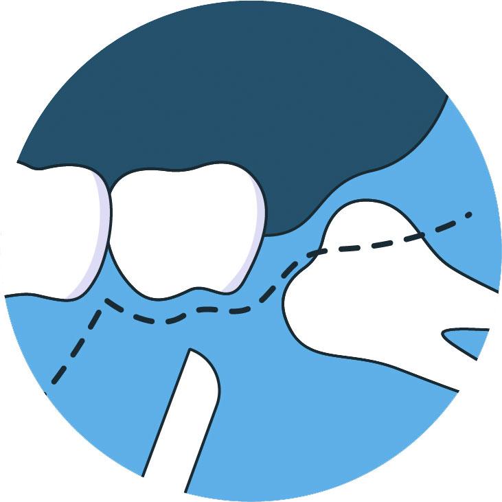 Wisdom tooth removal cost Dubai