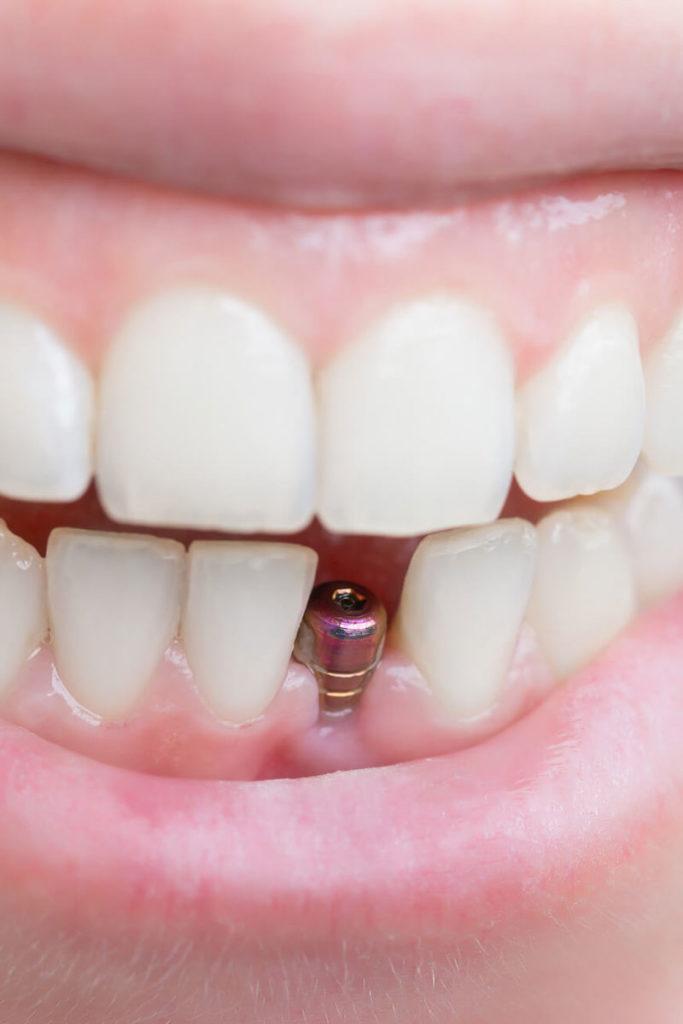 dental implant dubai