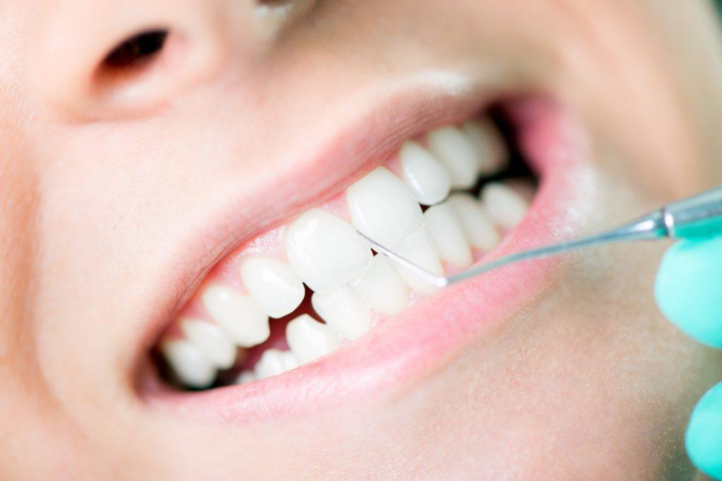invisalign-braces-cost-in-dubai