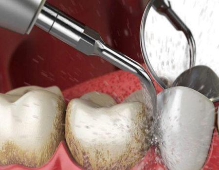 Tooth Cleaning and Polishing
