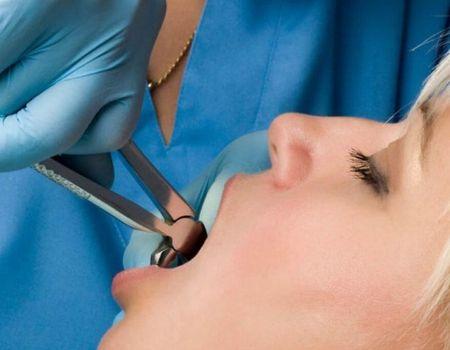  Tooth Extractions