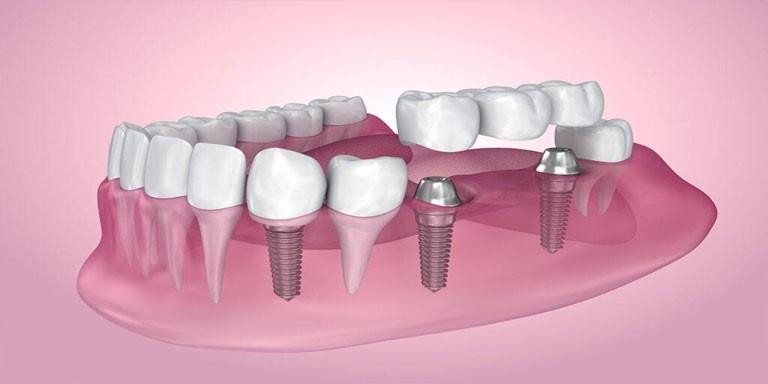 orthodontist in International City Dubai