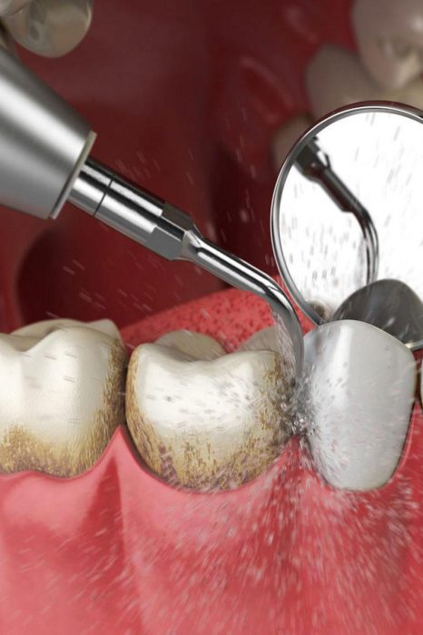 tooth-cleaning-and-polishing