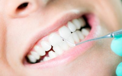 invisalign-braces-cost-in-dubai